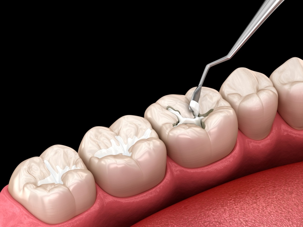 amalgam vs composite fillings